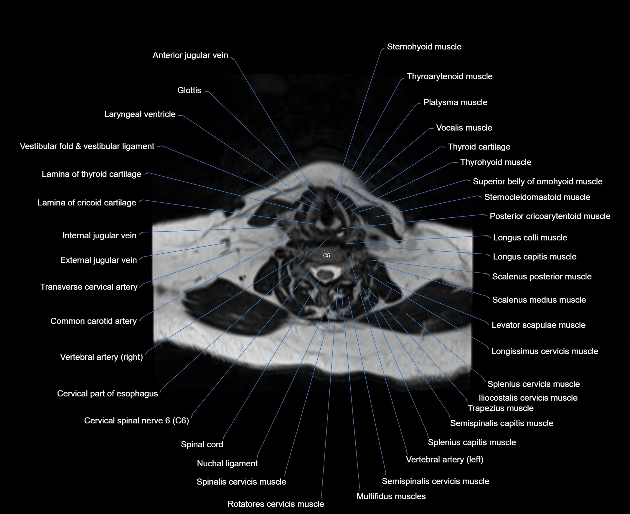 MRI Neck 3D labelled cross section anatomy axial 3t image-00001-00061.webp